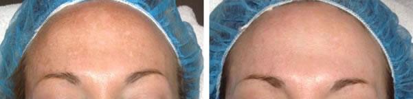 Microneedling Before and After photo by Spa One at The Plastic Surgery Group in Albany NY