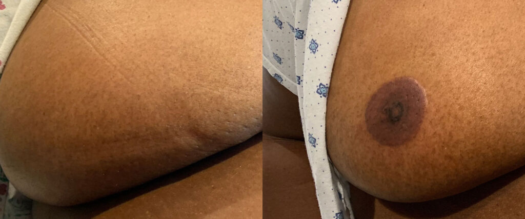 Paramedical Tattooing Before and After photo by Spa One at The Plastic Surgery Group in Albany NY