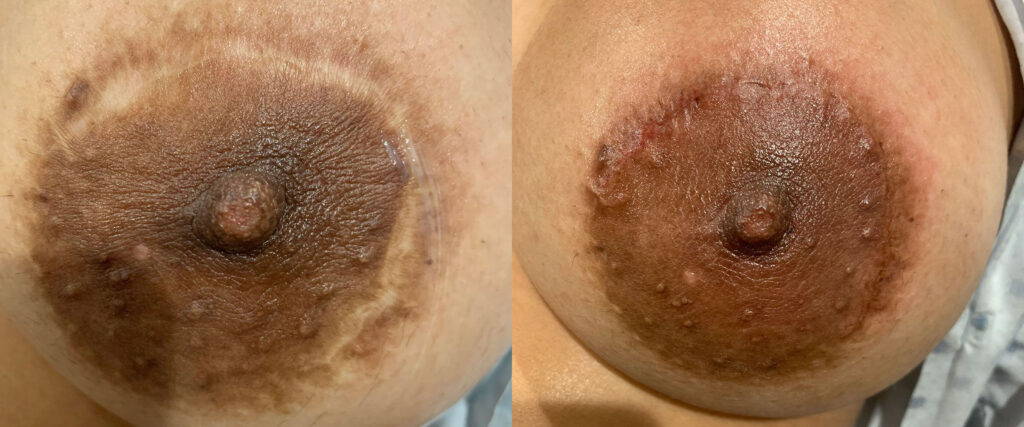 Paramedical Tattooing Before and After photo by Spa One at The Plastic Surgery Group in Albany NY