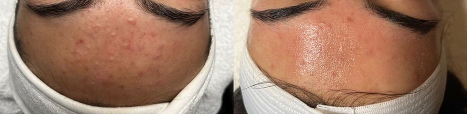 AviClear Laser Before ans After Photo by Spa One in Albany NY